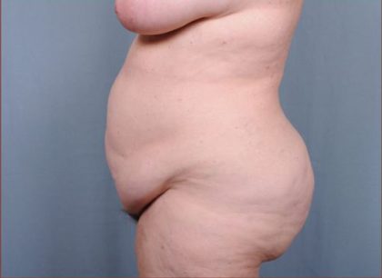 Abdominoplasty Before & After Patient #1887