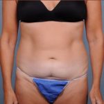 Abdominoplasty Before & After Patient #1886