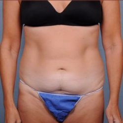 Abdominoplasty Before & After Patient #1886