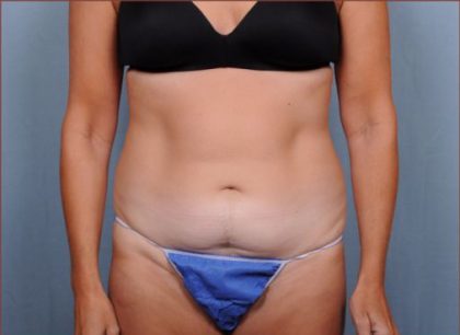 Abdominoplasty Before & After Patient #1886
