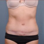 Abdominoplasty Before & After Patient #1886