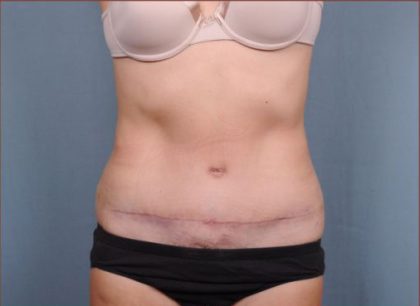 Abdominoplasty Before & After Patient #1886