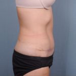 Abdominoplasty Before & After Patient #1886