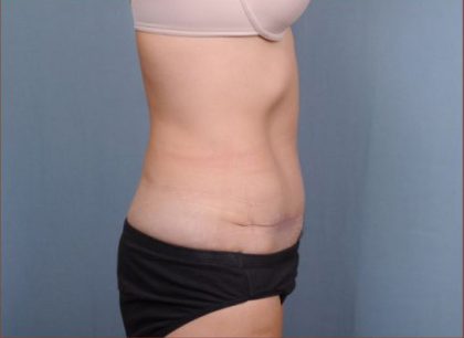 Abdominoplasty Before & After Patient #1886