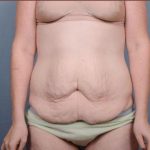 Abdominoplasty Before & After Patient #1885