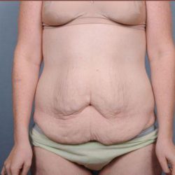 Abdominoplasty Before & After Patient #1885
