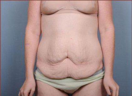 Abdominoplasty Before & After Patient #1885