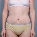 Abdominoplasty Before & After Patient #1885