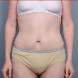 Abdominoplasty Before & After Patient #1885