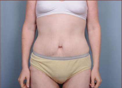 Abdominoplasty Before & After Patient #1885