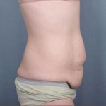 Abdominoplasty Before & After Patient #1885