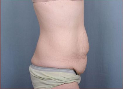 Abdominoplasty Before & After Patient #1885