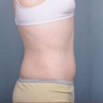 Abdominoplasty Before & After Patient #1885