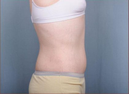 Abdominoplasty Before & After Patient #1885