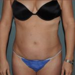 Abdominoplasty Before & After Patient #1883