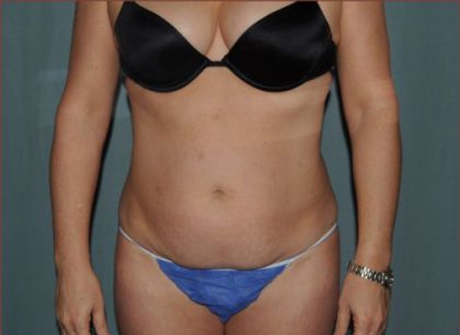 Abdominoplasty Before & After Patient #1883