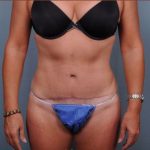 Abdominoplasty Before & After Patient #1883
