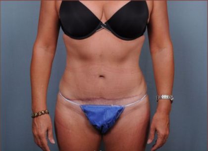 Abdominoplasty Before & After Patient #1883