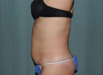 Abdominoplasty Before & After Patient #1883