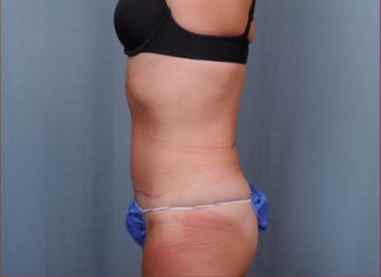 Abdominoplasty Before & After Patient #1883