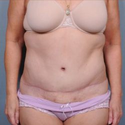 Abdominoplasty Before & After Patient #1890