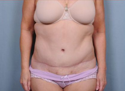 Abdominoplasty Before & After Patient #1890