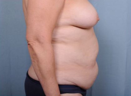 Abdominoplasty Before & After Patient #1890