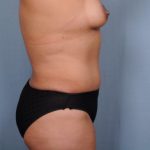 Abdominoplasty Before & After Patient #1884
