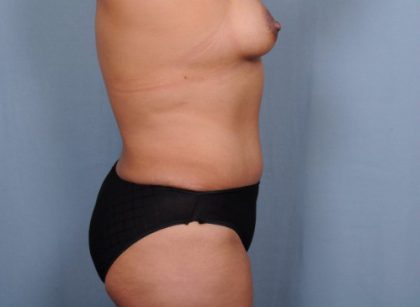 Abdominoplasty Before & After Patient #1884