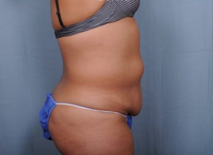 Abdominoplasty Before & After Patient #1884