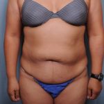 Abdominoplasty Before & After Patient #1884