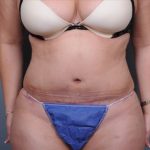 Abdominoplasty Before & After Patient #1882