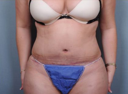 Abdominoplasty Before & After Patient #1882