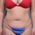 Abdominoplasty Before & After Patient #1882