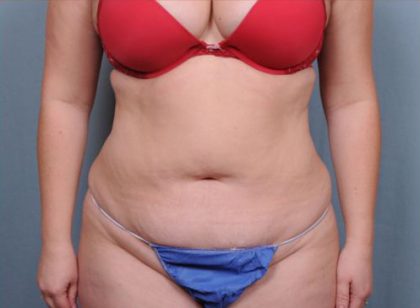 Abdominoplasty Before & After Patient #1882