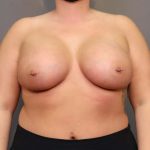 Breast Augmentation Before & After Patient #3109
