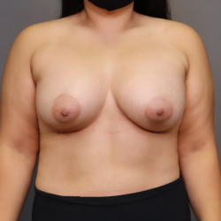 Breast Augmentation Before & After Patient #3098