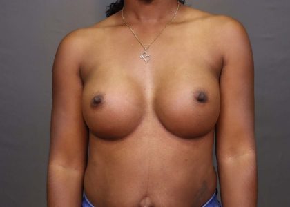 Breast Augmentation Before & After Patient #3097
