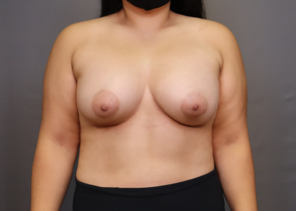 Breast Augmentation Before & After Patient #3098