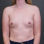 Breast Augmentation Before & After Patient #3174