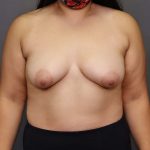 Breast Augmentation Before & After Patient #3098