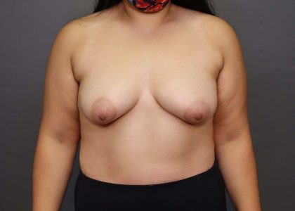 Breast Augmentation Before & After Patient #3098