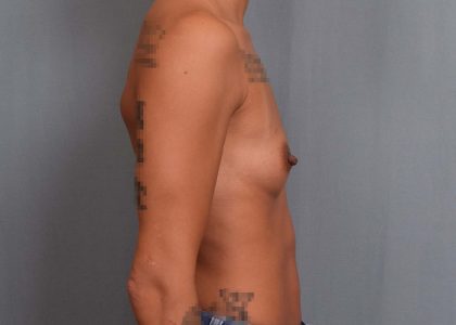 Breast Augmentation Before & After Patient #3091
