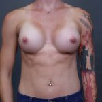 Breast Augmentation Before & After Patient #3136