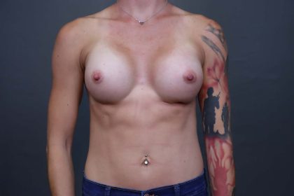 Breast Augmentation Before & After Patient #3136