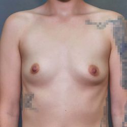 Breast Augmentation Before & After Patient #3135