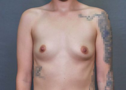 Breast Augmentation Before & After Patient #3135