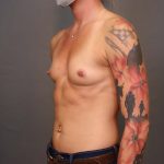 Breast Augmentation Before & After Patient #3136