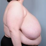 Breast Reduction Before & After Patient #2006