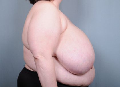 Breast Reduction Before & After Patient #2006